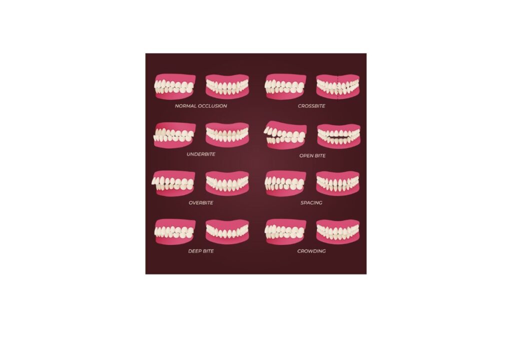Why is Jaw Surgery Considered?